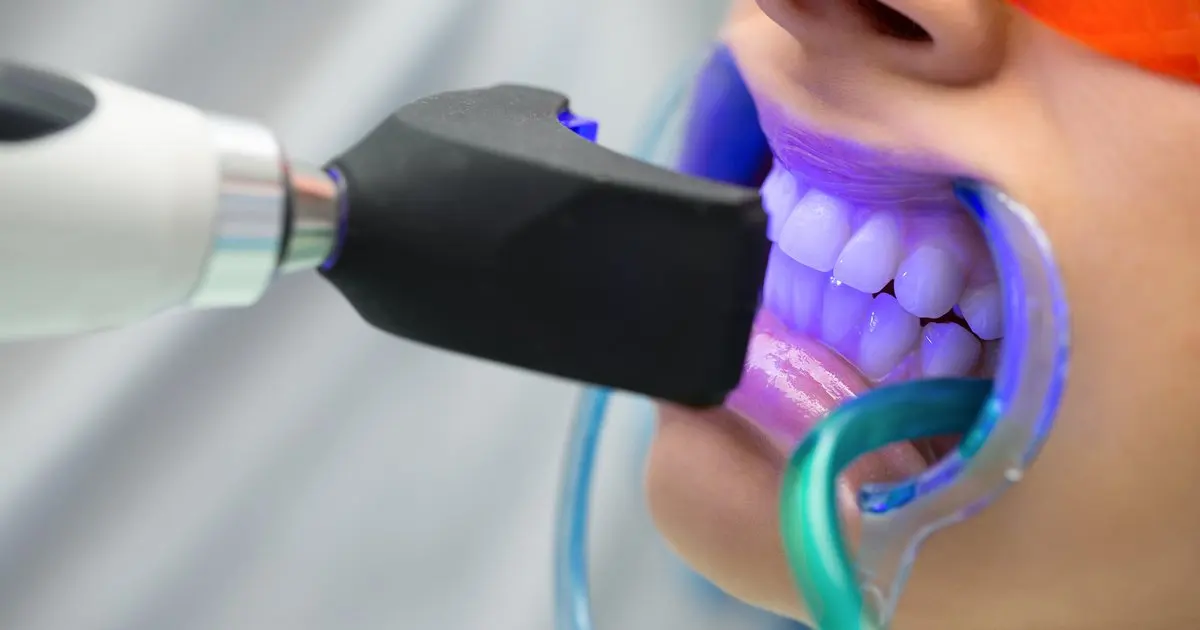 Blanqueamiento dental: cómo funciona y qué debes saber